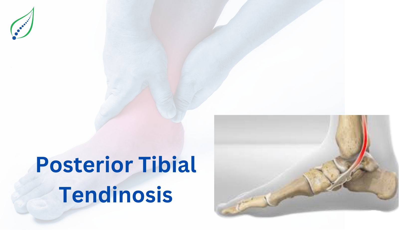Posterior Tibialis Tendinosis
